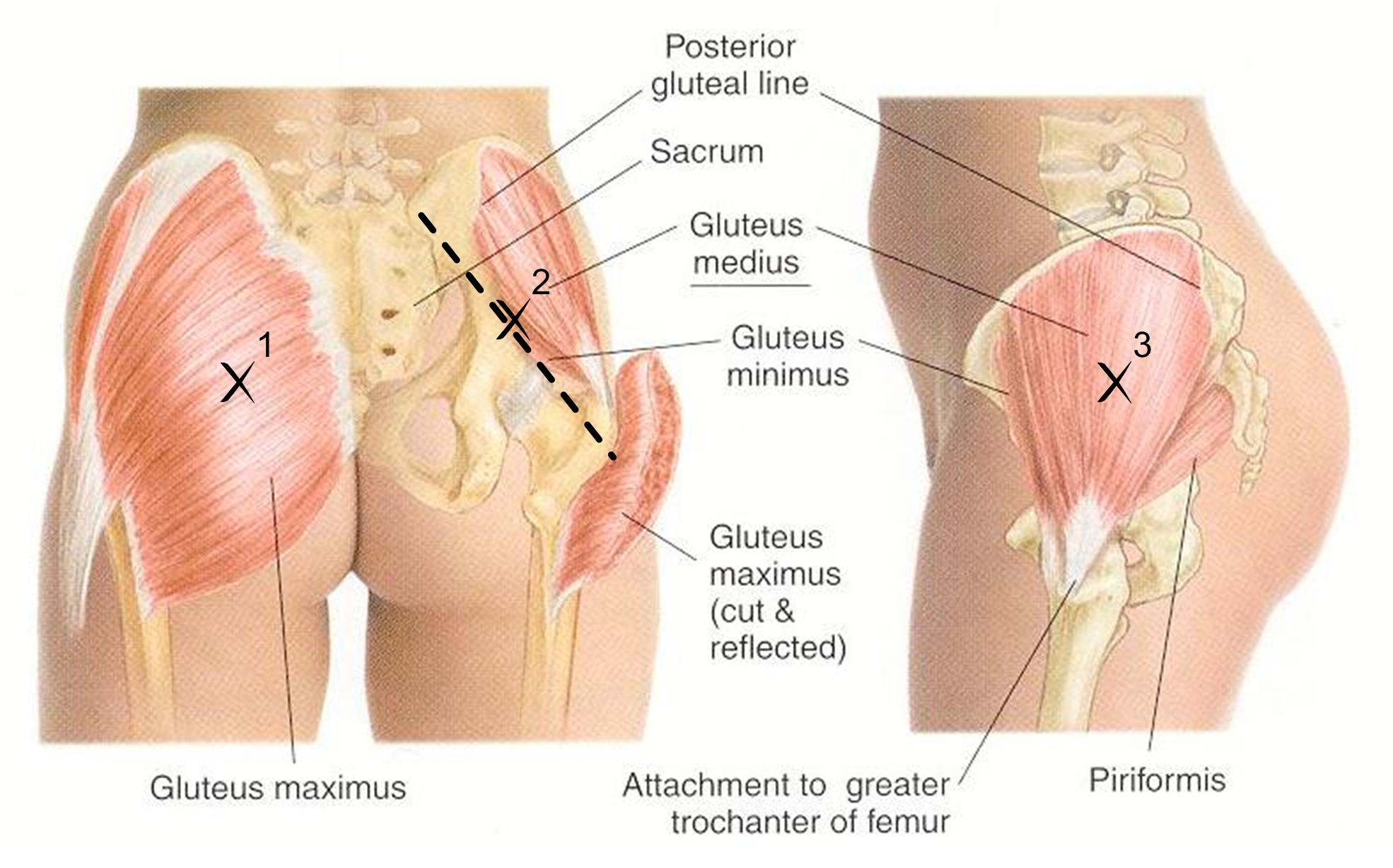 gluteal tendinopathy exercises pdf